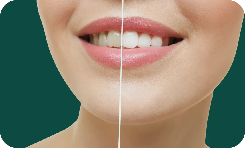 blanchiment-fin-traitement