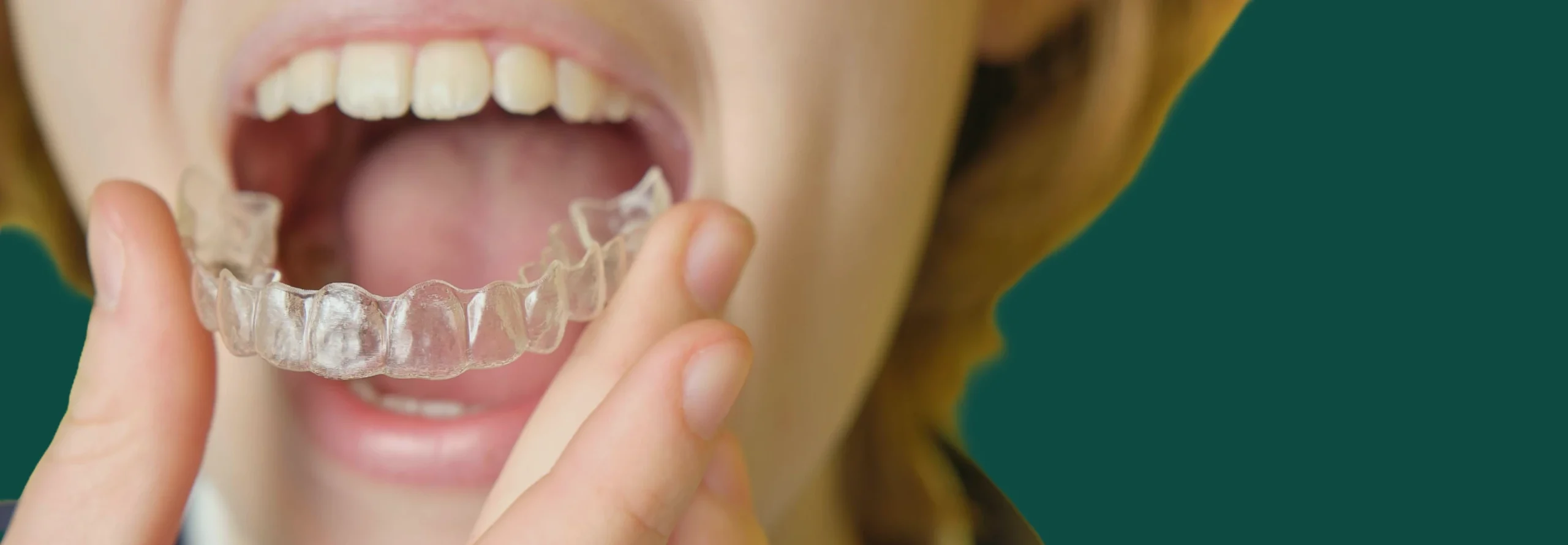orthodontie adolescents bruxelles bianchi